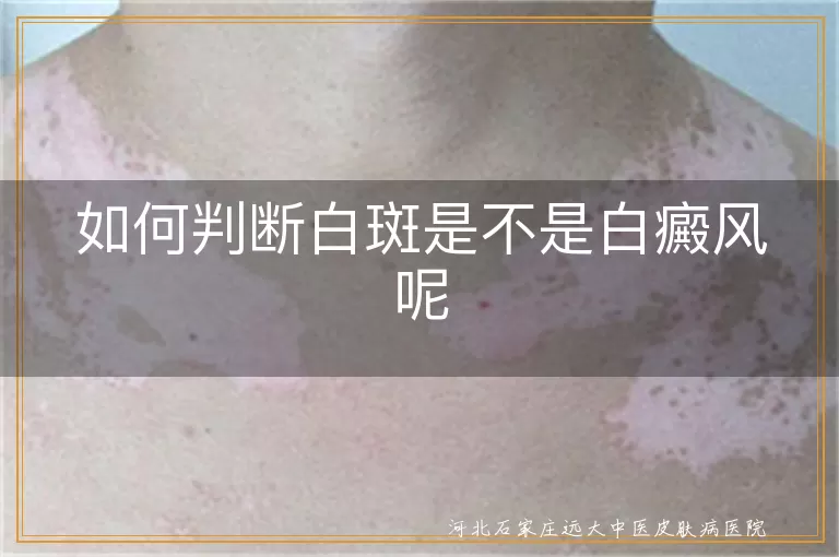 白癜风基本特征,白斑变化情况,专业设备检查白癜风,结合症状判断白斑