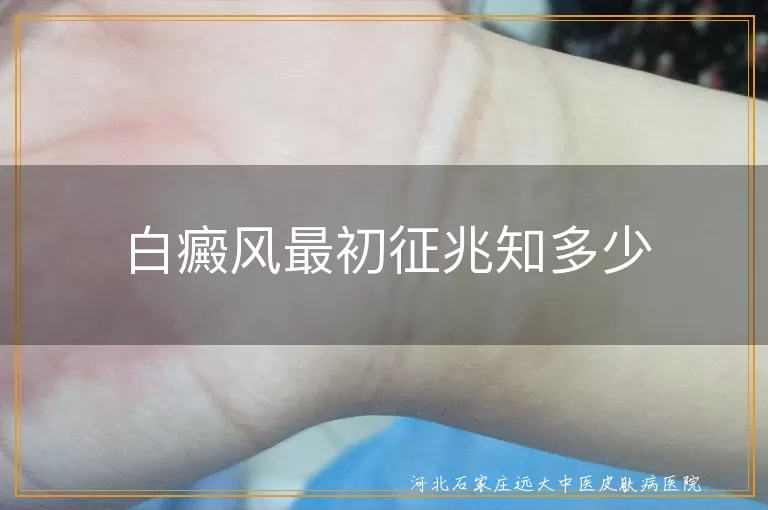 白癜风初期白斑特征,白癜风扩散趋势,白癜风伴随症状,白斑图片识别