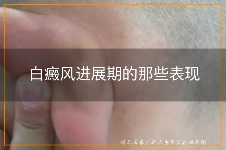 白癜风进展期白斑扩散,白癜风颜色变化明显,白癜风新白斑出现,白癜风心理社交影响