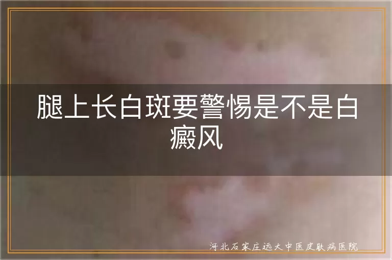 腿上白斑与白癜风,白癜风白斑特点,白斑扩散性,白癜风预防治疗