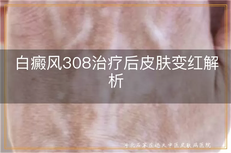 白癜风308治疗后变红原因,白癜风皮肤变红处理办法,白斑308激光后反应,白癜风治疗后护理建议
