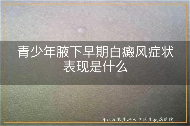青少年腋下白癜风症状,白斑初期表现,青少年白癜风特征,腋下白斑症状