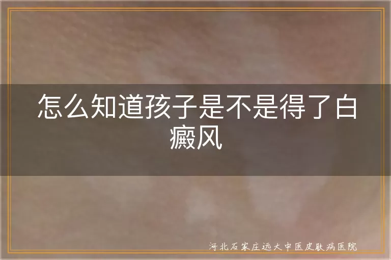 孩子白癜风症状,白斑扩散情况,白癜风诊断方法,儿童白斑治疗