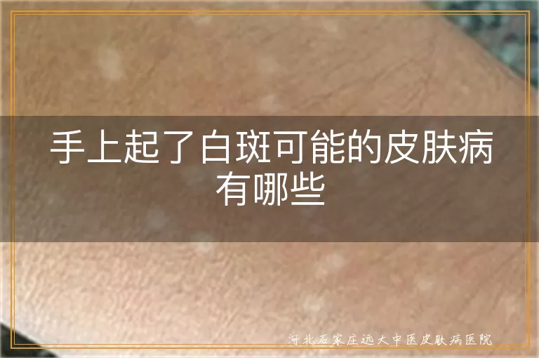 手上白斑可能是白癜风,手上起白斑的皮肤病,无色素痣导致白斑,白色糠疹白斑特点
