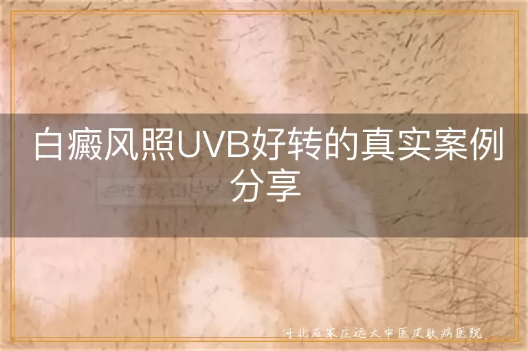 白癜风照UVB好转症状, 白斑治疗UVB案例, 白癜风UVB光疗效果, 白斑UVB治疗真实案例