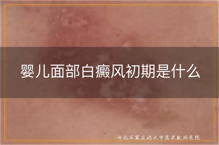 婴儿面部白癜风初期症状,婴儿白癜风白斑特征,婴儿面部白斑处理,婴儿面部白癜风治疗
