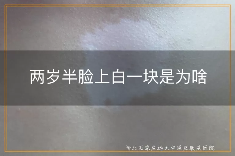 两岁半脸上白斑原因,宝宝白癜风症状,儿童白斑疾病,幼儿脸上白一块咋回事