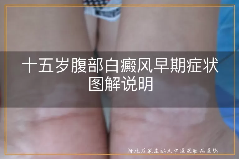 青少年白癜风症状,腹部白斑初期表现,白癜风早期识别图,儿童白斑病症状图