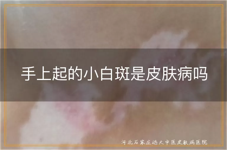 手上白斑是白癜风吗,手上小白点皮肤病,白斑原因有哪些,缺乏维生素导致白斑
