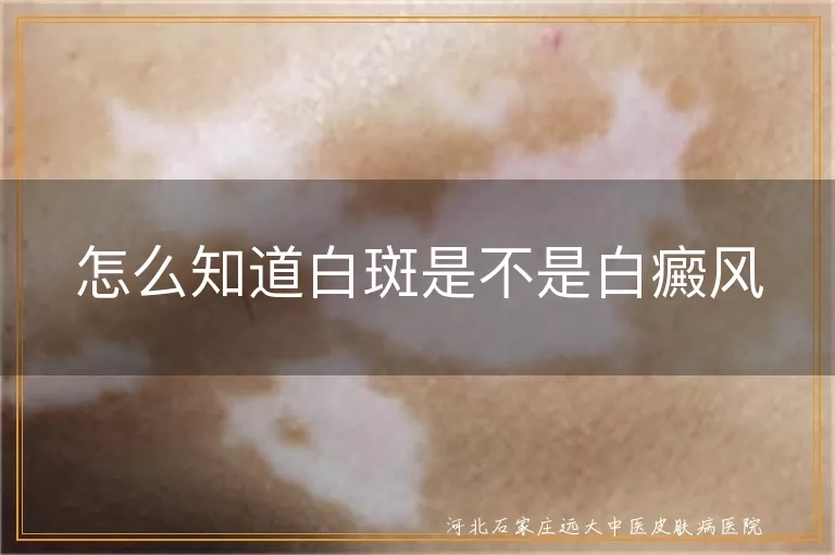 白斑症状与白癜风,伍德灯检查白癜风,白癜风确诊方法,白癜风预防措施
