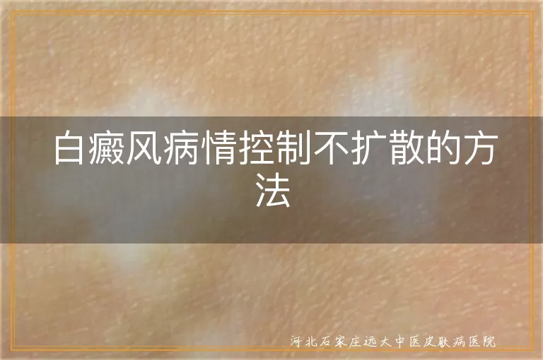 白癜风病情控制方法,白斑不扩散技巧,白癜风日常护理建议,白斑预防复发措施