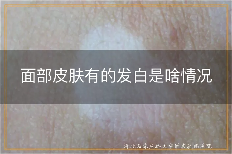 面部白癜风症状,白斑病原因,皮肤发白治疗,色素脱失性疾病
