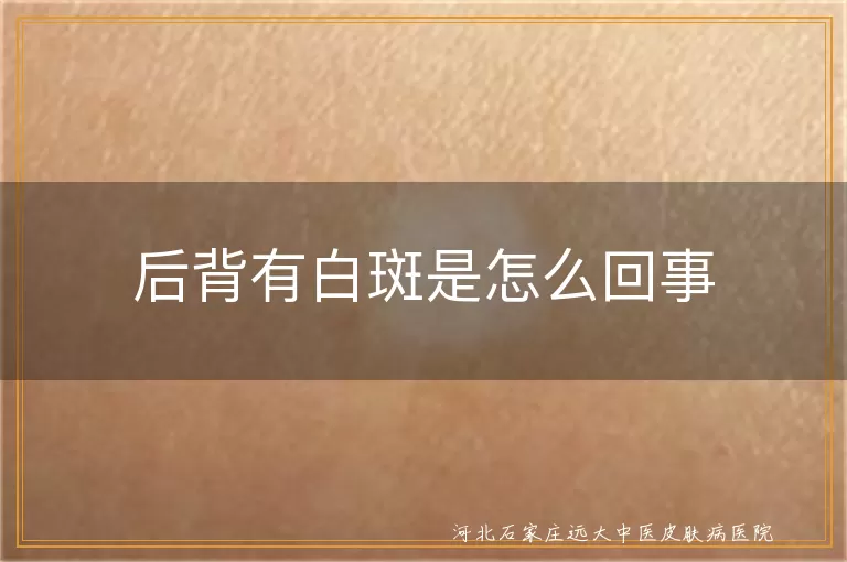 后背白斑原因,白癜风症状,白斑治疗方法,预防白斑策略