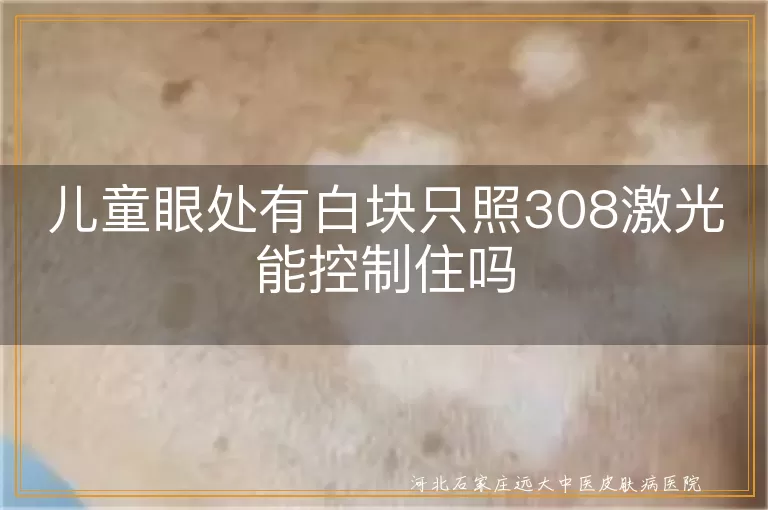 儿童白癜风308激光治疗,儿童白斑308激光效果,白癜风308激光治疗儿童,白斑308激光儿童治疗