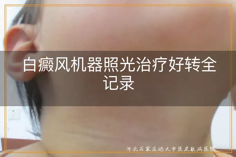 白癜风机器照光效果,白斑颜色变化过程,光疗促进黑色素再生,白癜风治疗经验分享