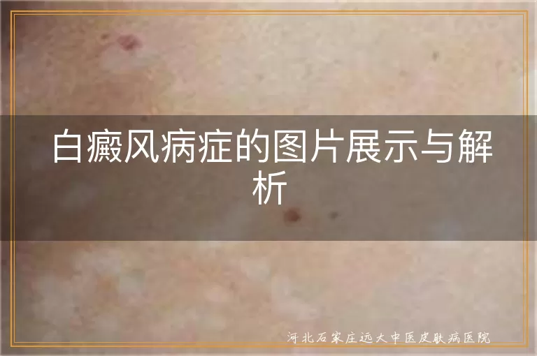 白癜风初期症状图片,白癜风发展期表现,白癜风稳定期特点,特殊类型白癜风图片