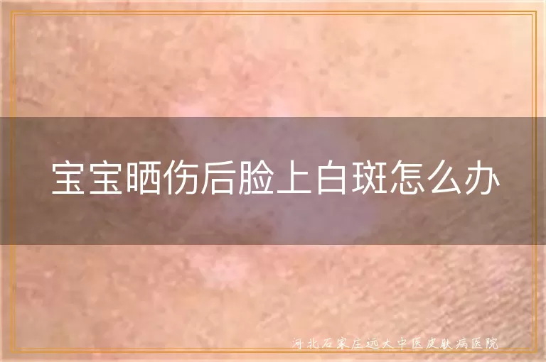 宝宝晒伤后白斑处理,白斑与白癜风区别,儿童晒后白斑护理,宝宝白斑消退方法