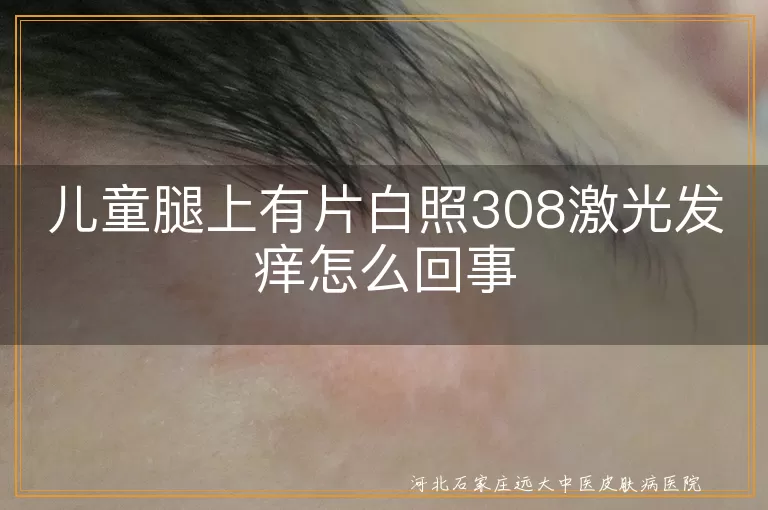 儿童白斑照308激光发痒原因,白斑照308激光发痒怎么办,儿童白癜风照308激光发痒,儿童照308激光后白斑痒