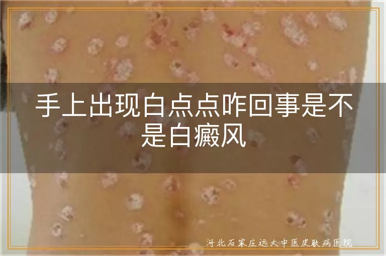 手上白斑原因,白癜风症状特点,白点点与白癜风区别,特发性白斑表现