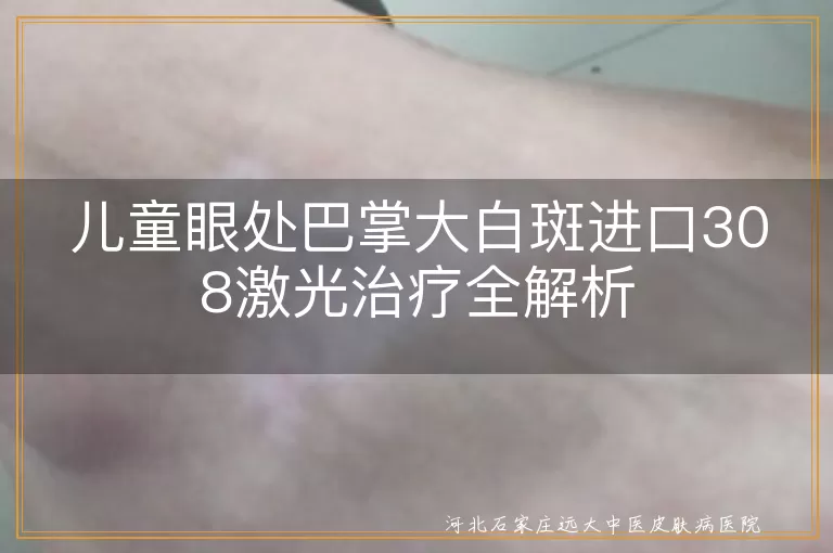 儿童白癜风进口308激光治疗, 眼处白斑治疗方法, 进口激光治白斑效果, 白斑儿童治疗全解析