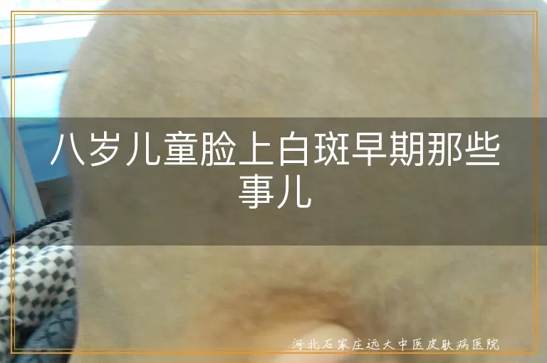8岁儿童白癜风早期表现,儿童脸上白斑症状,白癜风初期症状,儿童白斑鉴别诊断