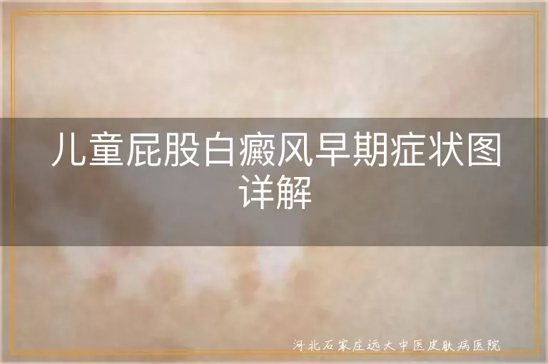 儿童屁股白癜风症状,白斑早期表现,白癜风初期特征,儿童白斑识别