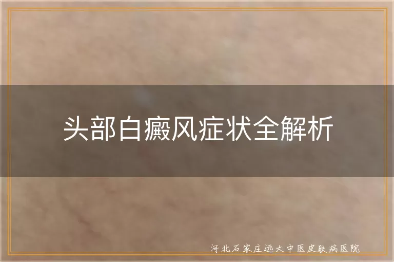 头部白癜风症状,白斑表现,白发与白癜风,头皮瘙痒与白斑