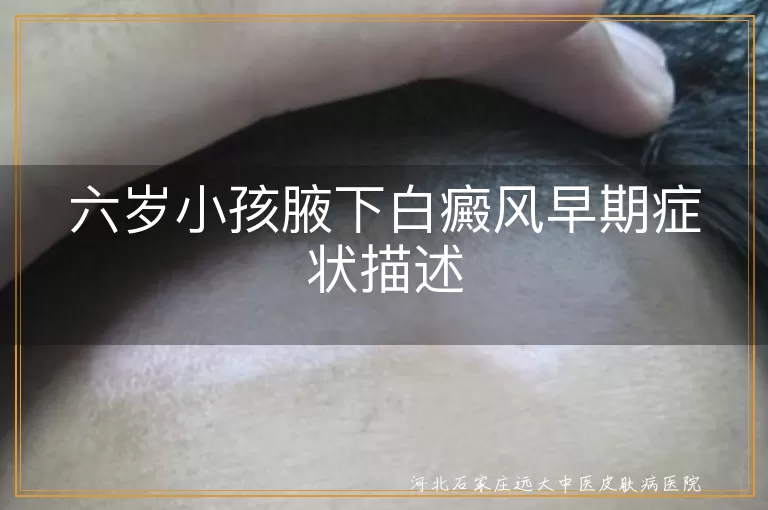 儿童腋下白癜风初期表现,小儿白斑症状图解,白癜风早期识别方法,幼儿白斑初期图片