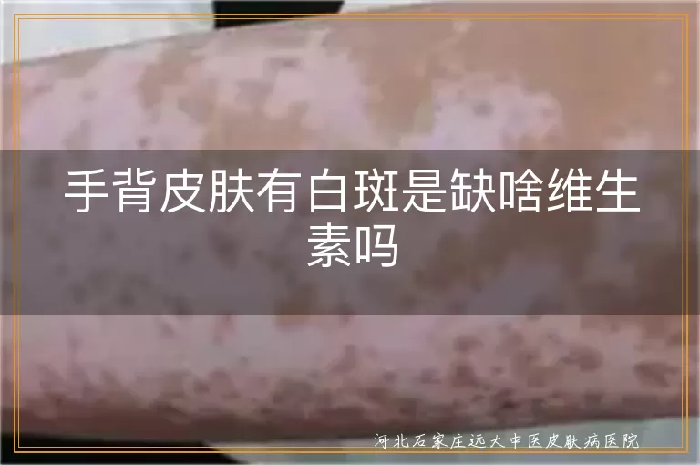 手背白斑与白癜风关系,维生素缺乏与白斑,白斑预防方法,白斑治疗措施