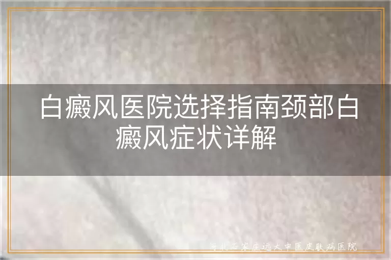 颈部白癜风症状,白癜风医院选择,白斑表现,专业白癜风治疗