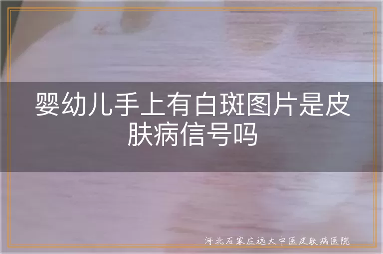 婴幼儿白癜风症状,手上白斑是皮肤病吗,白癜风早期识别,儿童白斑病因