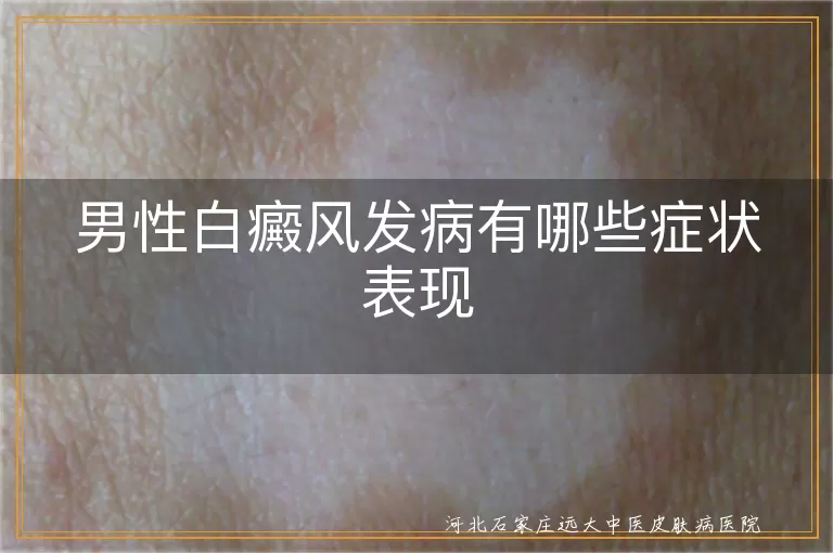 男性白癜风发病有哪些症状表现