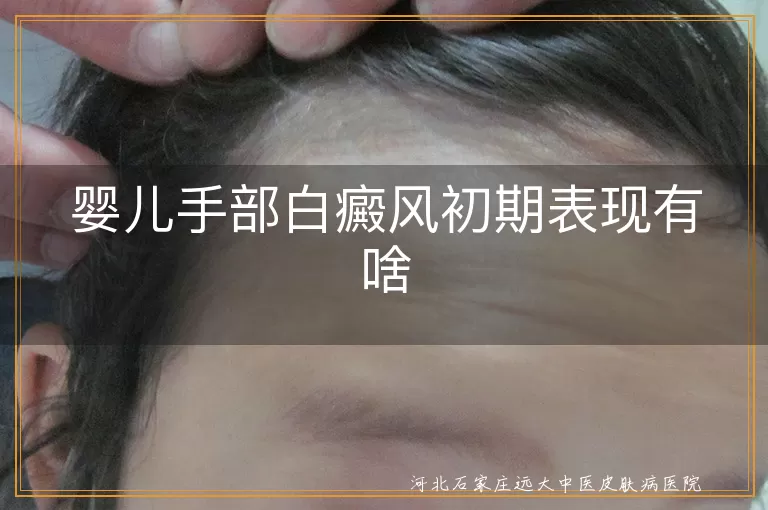 婴儿手部白癜风初期症状,白癜风白斑特点,婴儿白癜风预防方法,儿童白癜风早期表现