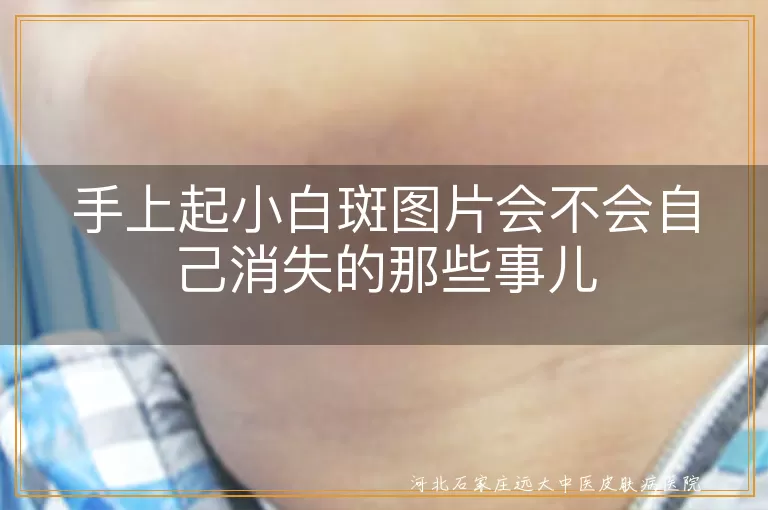 手上白斑自行消失,白癜风症状表现,白斑治疗方法,皮肤白斑原因