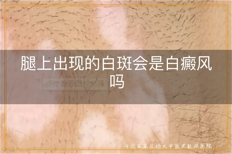 腿上白斑原因,白癜风症状特点,白斑诊断方法,白癜风治疗手段