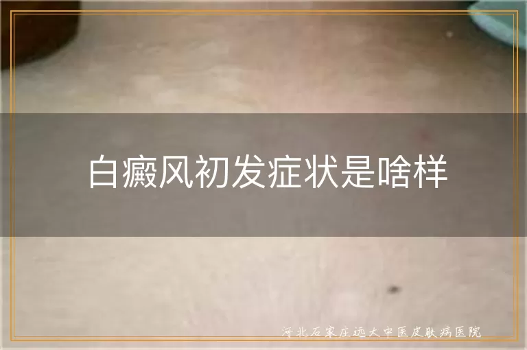 白癜风初发白斑,白斑边缘特征,白斑逐渐扩散,白斑处毛发变白