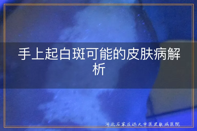 手上白斑可能是白癜风,白色糠疹导致白斑,无色素痣白斑表现,手上起白斑皮肤病