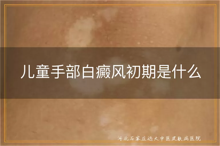 儿童手部白癜风初期症状, 白癜风初期白斑表现, 儿童白斑初期识别, 白斑初期应对方法