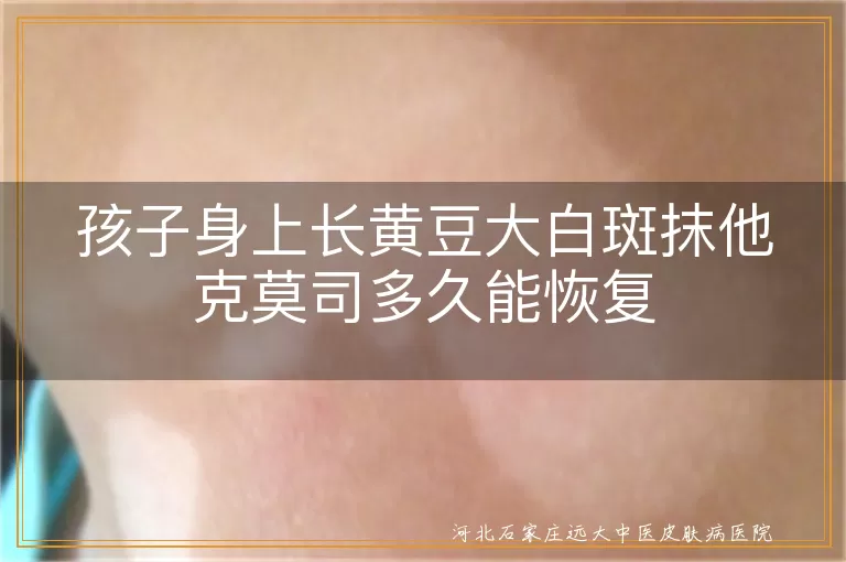 孩子白癜风治疗时间,黄豆大白斑他克莫司效果,儿童白斑恢复周期,白癜风药物治疗多久见效