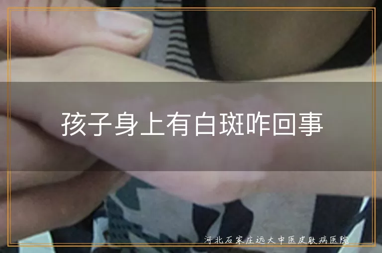 孩子白癜风原因,儿童白斑起因,白癜风症状识别,儿童白斑治疗方法