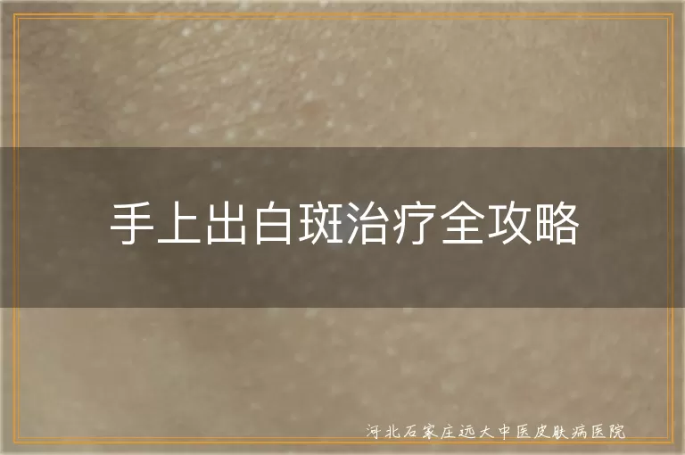 手上白癜风治疗方法,白斑如何消除,白癜风光疗效果,预防白斑复发