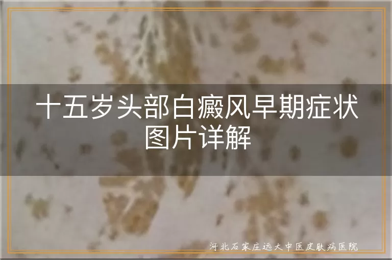 15岁头部白癜风早期症状
,青少年白斑初期表现
,头皮白癜风早期图片
,儿童白癜风初期症状图