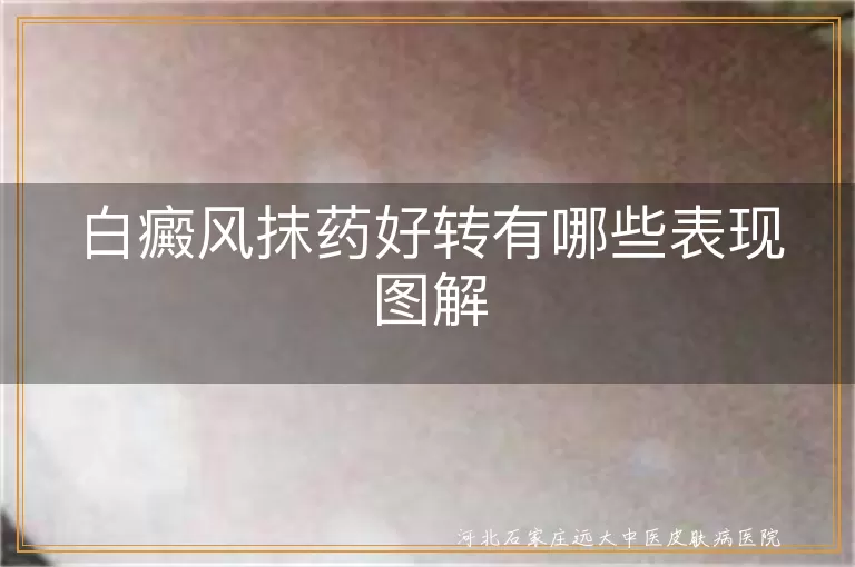 白癜风边缘模糊,白斑内色素岛出现,白癜风皮肤颜色均匀,白斑症状减轻