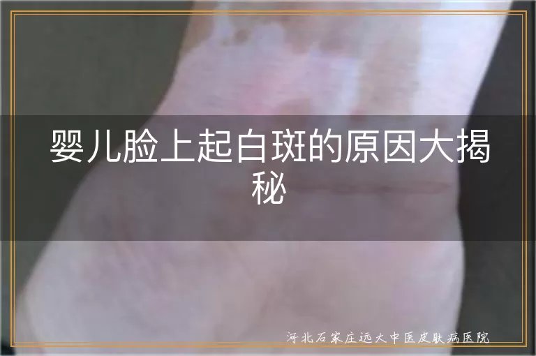 婴儿白斑原因揭秘, 婴儿白癜风症状, 婴儿脸上白斑怎么办, 婴儿白斑预防与治疗