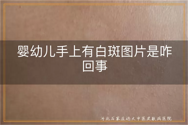 婴幼儿白斑原因白癜风,宝宝手上白斑咋回事,白斑与白癜风区别,婴幼儿白斑治疗与护理