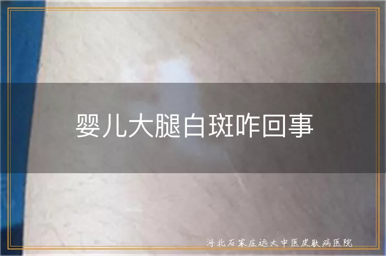 婴儿大腿白斑原因,白癜风鉴别方法,宝宝白色糠疹症状,婴儿贫血痣表现
