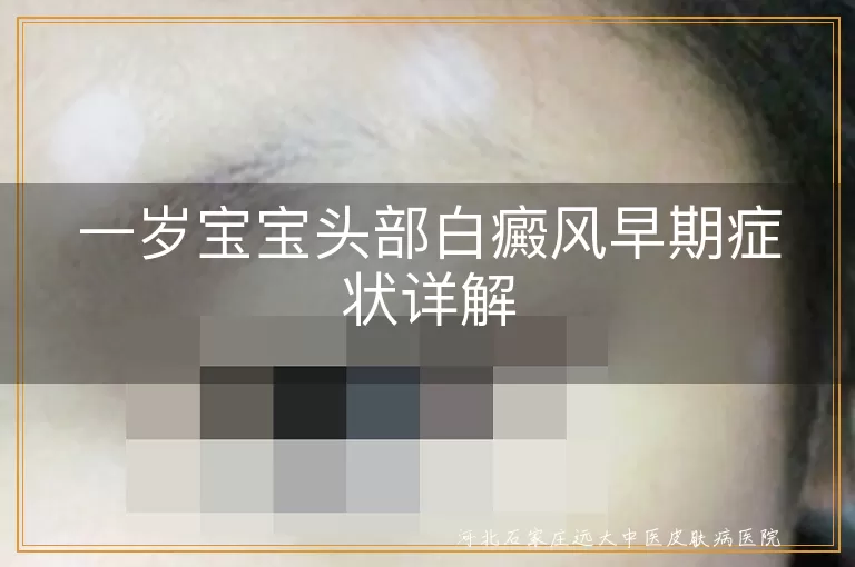宝宝头部白癜风症状, 白斑初期表现, 婴幼儿白癜风特点, 白癜风早期识别