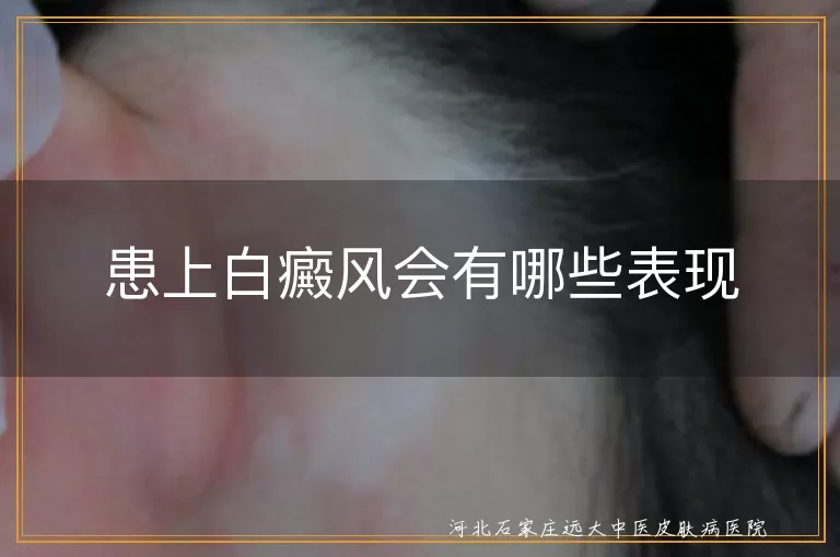 白癜风白斑症状,白癜风边缘变化,白癜风感觉异常,白癜风并发症