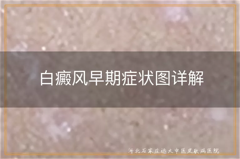 白癜风早期白斑特点,白癜风白斑变化过程,伍德灯检查白癜风,白癜风早治疗重要性