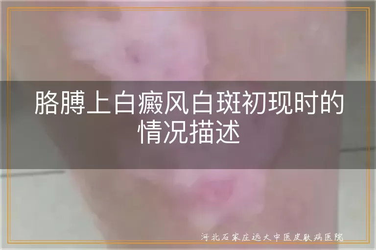 胳膊白癜风初期症状,白斑边缘模糊性,白癜风与免疫力关系,白斑早期发现与治疗